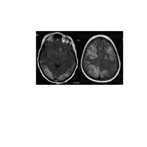 MRI brain, FLAIR sequence, axial images revealing hyperintense lesions posteriorly and frontally bilaterally.